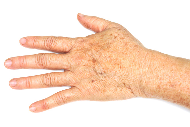 Sign of aging - freckles on hand