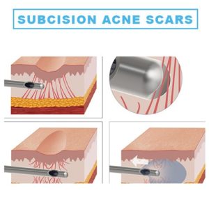 Subscision acne scars