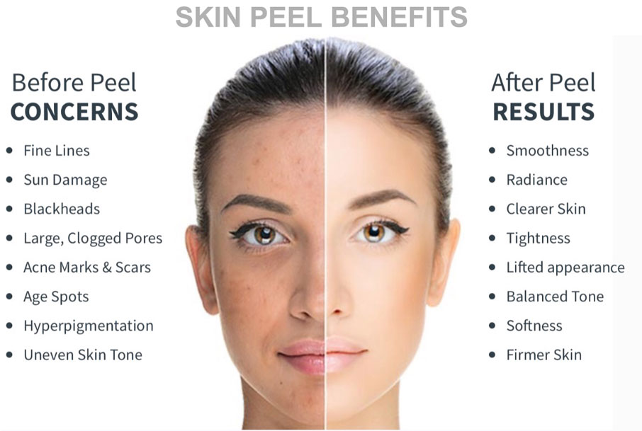 peelresults.webp